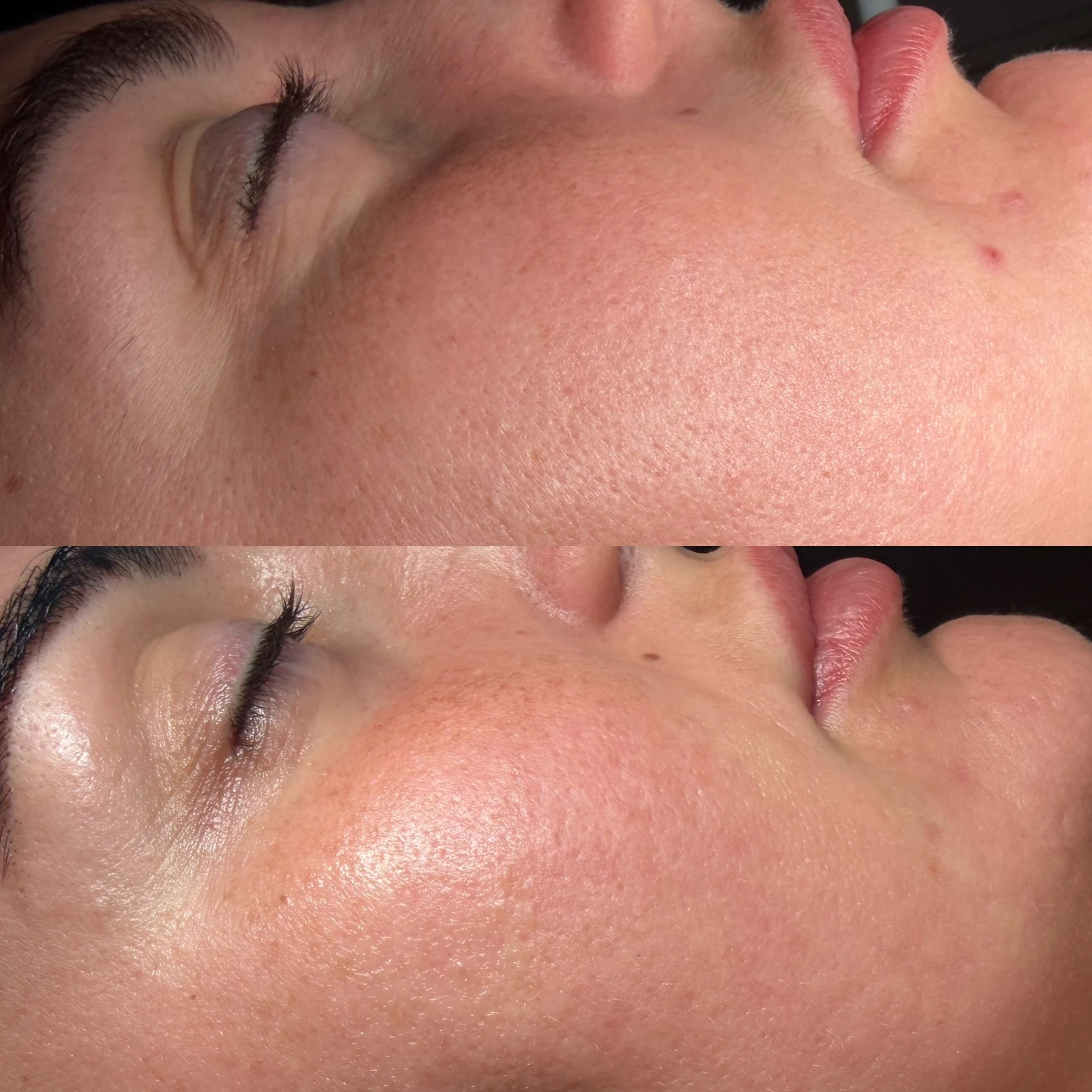 Skin treatment before and after at Front Row Beauty Bar